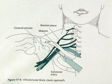 Plexus brachialis block Plexus Brachialis, Crna School, Chronic Pain, Figure Drawing, Plexus Products, Anatomy, Nursing, Drawings