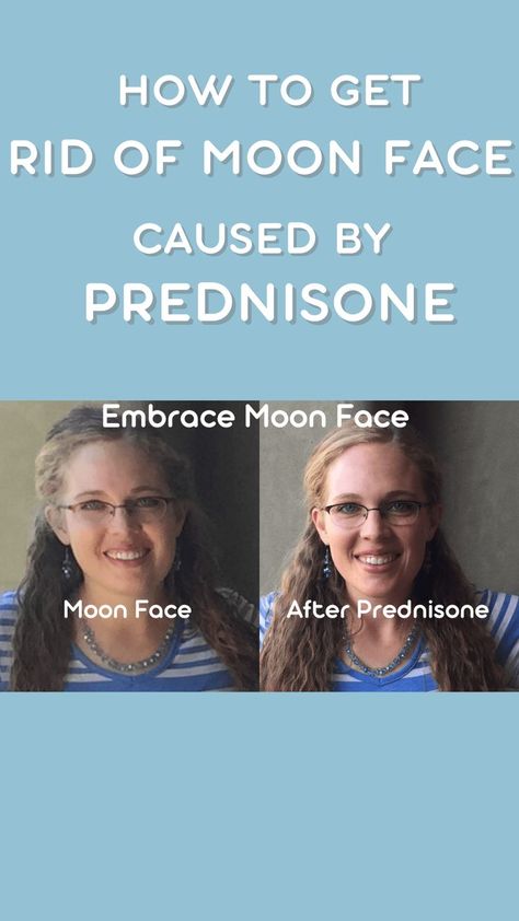 #moonface#prednisone#bloating#prednisonesideeffects Prednisone causes an unpleasant disfiguration of the face called Moon Face. Fat is deposited on the cheeks and neck making the face appear round like the moon. Prednisone Moon Face, Prednisone Side Effects, Bloated Face, Autoimmune Disease Symptoms, Losing Weight After 40, Face Fat, Face Tips, Face Change, Skin Natural Remedies