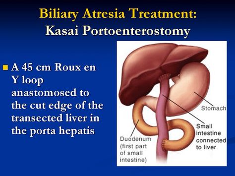 Kasi procedure explained for Biliary Atresia Biliary Atresia, Neonatal Nursing, Organ Donation Awareness, Neonatal Nurse, Organ Donation, Nursing, Medicine