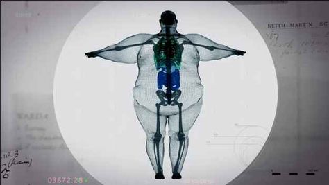 This image of an apparent X-ray of a 70-stone (980-pound) man has gone viral after trending heavily on Twitter . | This Is What A 980-Pound Man Looks Like On The Inside Big Boned, Respiratory Therapy, Radiology, Pisco, X Ray, Plastic Surgery, Take Care Of Yourself, Radios, A Man