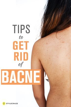 11 Simple Tips To Get Rid Of Bacne (Back Acne) Backne Remedies, Shoulder Acne, Tighten Stomach, Skin Firming Lotion, Skin Tightening Stomach, Chest Acne, Back Acne, Skin Bumps, Get Rid Of Acne