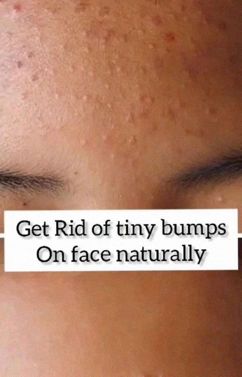 Tiny Bumps On Face, White Bumps On Face, Bumps On Face, Dark Under Eye Circles, Under Eye Circles, Face Home, Healthy Quotes, Midsize Style, Dark Under Eye