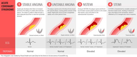 Stemi Vs Nstemi, Cath Lab Nursing, Pathophysiology Nursing, Nurse Brain Sheet, Acute Coronary Syndrome, Medical Ultrasound, Nurse Inspiration, Cardiac Nursing, Umbrella Term