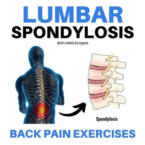 Dr. Caleb Burgess DPT OCS CSCS on Instagram: "💥Lumbar Spondylosis💥 📚 Lumbar spondylosis is a generalized term used to describe any and all degenerative conditions affecting the discs, vertebral bodies, and/or associated joints of the lumbar spine 🧓🏼 So basically, as your spine begins to show signs of aging, it could be described as lumbar "spondylosis" 🤯 In fact, over 80% of people over the age of 40 have lumbar spondylosis ➡️ This can be asymptomatic (without symptoms) or symptomatic (wit Spondylosis Lumbar, Lumbar Spondylosis, Lumbar Pain, Nose Picking, Lumbar Spine, Hip Flexor Stretch, Pelvic Tilt, Hamstring Stretch, Back Pain Exercises