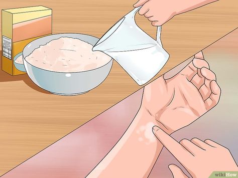 Get Rid Of Hives Fast, Allergic Reaction Remedies, How To Treat Hives, Natural Remedies For Hives, Allergy Hives, Hives Causes, Allergic Reaction Rash, Itchy Skin Rash, Rashes Remedies