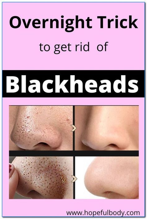 HOW TO REMOVE BLACKHEADS FROM NOSE & FACE Remove Blackheads From Nose, Blackhead Remover Diy, For Blackheads, To Remove Blackheads, Blackheads On Nose, Rid Of Blackheads, Cold Medicine, Choreography Aesthetic, Cold Sores Remedies