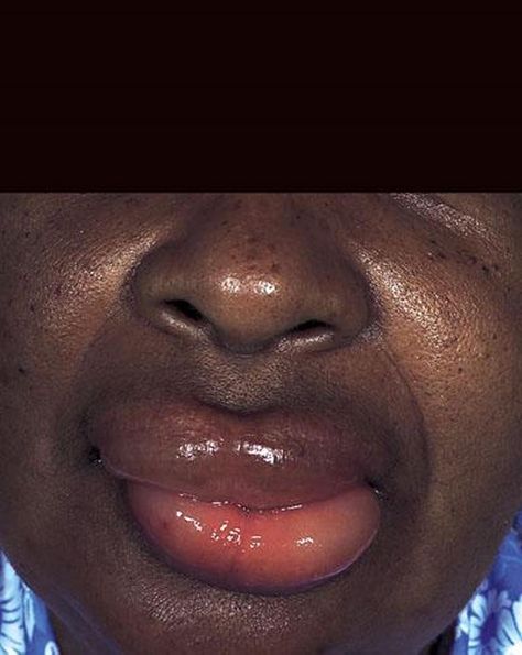 Angioedema Sore Mouth And Tongue, Swelling Remedies, Immune Disorders, Dental Animation, Swollen Lips, How To Relieve Nausea, Eating Fish, Rare Disorders, Swollen Tongue