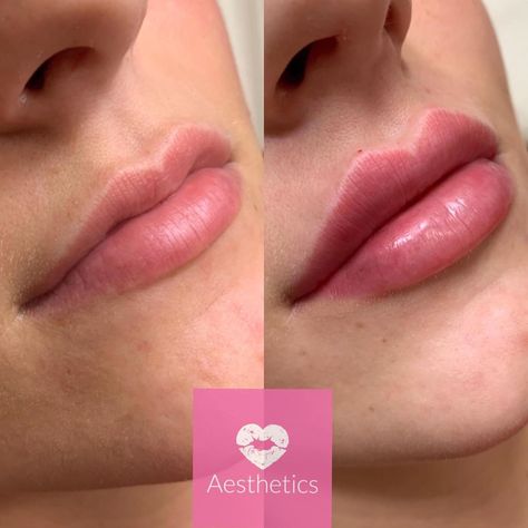 Facial Aesthetic Specialists on Instagram: “Fill the world with love 💉💖 Heart Sculpt lips : This technique aims to give you perfect heart shaped lips. Heart shaped lips are…” Facial Aesthetic, Heart Shaped Lips, Perfect Heart, Facial Aesthetics, You Are Perfect, Heart Shape, Heart Shapes, Facial, Lips