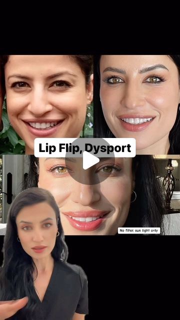 Lone Tree Aesthetics Medical Spa on Instagram: "Injecting in this area relaxes the muscle, which allows the upper lip to roll outward, creating a fuller, more defined look. I used 24 units of Dysport which equals 8 units of Botox . #lipflip #lipflipresults #dysport #dysportinjections #beforeandafter #fullerlips #nurseinjector #botulinumtoxin #reelsinstagram #ig #instagood" Botox Lips, Botulinum Toxin, Lone Tree, Medical Spa, Upper Lip, Spa, Medical, Lips, The Unit