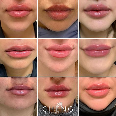 Cheng Plastic Surgery & Medspa on Instagram: “Lip Inspo ✨⁣ ⁣ Here is just a handful of our beautiful lip transformations done over the last month here at the office using a combination…” Perfect Lips Injections, Lip Injections Juvederm, Filler Transformation, Lip Fillers Juvederm, Lip Healing, Cosmetics Aesthetic, Lips Shape, Lips Inspiration, Botox Lips