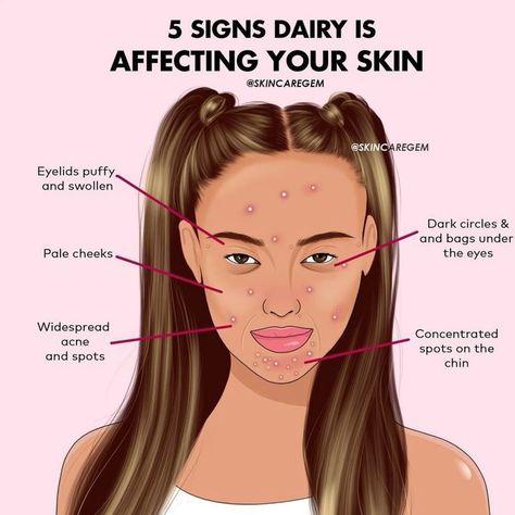 5 SIGNS DAIRY IS AFFECTING YOUR SKIN Clear Skin Diet, Oily Skin Acne, Skin Care Routine Order, Good Skin Tips, Treat Acne, Clear Skin Tips, Acne Spots, How To Get Rid Of Acne, Body Skin Care Routine