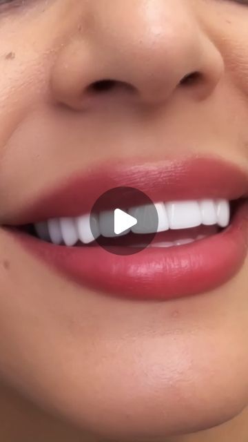 DaVinci Dental on Instagram: "Ever wondered what sets porcelain veneers apart from the rest? Let’s dive into the details! 💎 

Unlike other veneer materials, porcelain offers a natural translucence that mimics real teeth, ensuring a seamless blend with your smile. 🦷✨ The durability and stain resistance of porcelain veneers are unmatched, giving you a long-lasting, radiant smile. Discover the art and science behind your dream smile transformation with porcelain veneers!⁠
⁠
Visit the link in our bio  to schedule your consultation today, and achieve your brighter, whiter smile in no time!⁠
⁠
⁠
💎Da Vinci Dental ⁠
⁣📍Bellevue, WA ⁣⁣⁣& Newport  Beach, CA ⁣⁠
✈️ We see patients from all over the USA⁠
📲Complimentary Virtual/In-Office Consults⁠
💳Financing via CareCredit/LendingClub⁠
⭐️ 5 Stars o Teeth Veneers, Smile Transformation, Gum Surgery, Veneers Teeth, Porcelain Veneers, Dental Veneers, Smile Makeover, White Smile, Perfect Smile