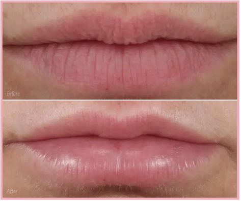 Vertical lip lines are notorious for giving away a person’s age. What’s more, everyday solutions to cover them up just don’t work. There are better nonsurgical solutions (this lip before and after is just one!) #botox #cosmeticinjectables #dermalfillers #fillers #injectables #PlateletRichPlasma #PRP Smoker Lines Before And After, Lip Filler For Smoker Lines, Best Lip Plumping Gloss, Smokers Lines, Mouth Wrinkles, Reverse Aging Skin, Botox Before And After, Botox Filler, Botox Lips