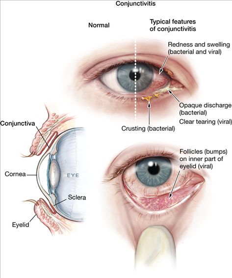 Eye Care Center, Eye Facts, Eye Anatomy, Eye Pain, Parts Of The Eye, Eye Infections, Pink Eye, Medical Anatomy, Eyes Problems