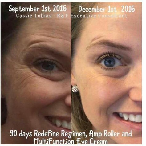 If you are ever skeptical about Rodan + Fields Before and Afters, and what these products really achieve, do yourself a favor and check out these 90 day results from a real person. With a  60 day money back guarantee,  what do you have to lose? Make this year a new you!  This is the signature Redefine regimen....after 90 days! Multifunction Eye Cream, Amp Md Roller, Redefine Regimen, Rodan And Fields Redefine, Creme Anti Age, Life Changing Skincare, Premium Skincare, Grande Cosmetics, Anti Aging Ingredients