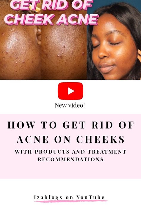 This Pin was discovered by Izablogs | Beauty blogger on skincare and natural hair. Discover (and save!) your own Pins on Pinterest. Acne On Cheeks, Cheek Acne, Clear Skin Naturally, Anti Aging Remedies, Get Rid Of Acne, Rid Of Acne, Types Of Acne, Black Bloggers, Blog Titles