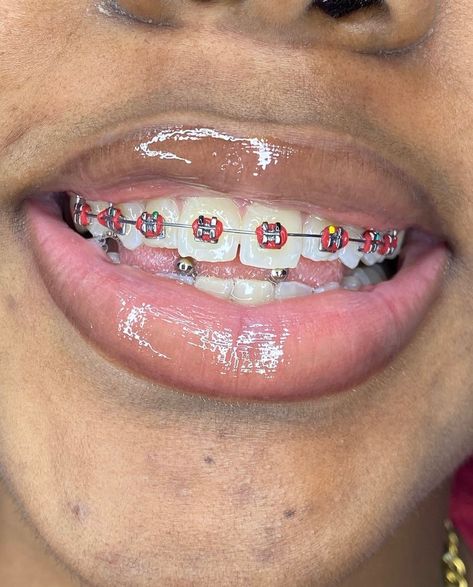 @bracesbytaiwo #fashion #style #beauty #photoftheday #stylish #love #cute #beautiful #instagood #fyp #braces #foryoupage Orange Braces, Cute Braces Colors, Getting Braces, Cute Braces, Braces Colors, Dental Braces, Love Cute, Baddie Outfits, Braces