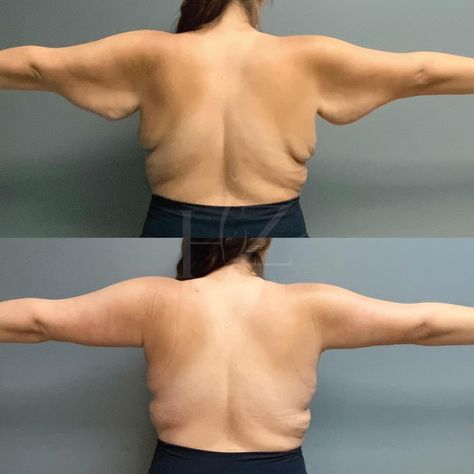 Arm lift after losing 170lbs 💪🏼 Our beautiful patient wanted to remove the excess, hanging skin on her arms after her impressive weight loss, so @drafsharihzps performed a brachioplasty (arm lift) to achieve her goals. Results are 3 months post-op! 𝐏𝐫𝐞-𝐎𝐩 𝐒𝐭𝐚𝐭𝐬: Age: 31, Height: 5ft 8in, Weight: 225lbs, BMI: 34 𝐃𝐞𝐭𝐚𝐢𝐥𝐬: ✨ By @drafsharihzps 🥼 Board-certified surgeon 📲 Virtual + in-person consults 💵 Financing + layaway available 🧐 Unlock pricing (link in bio) 🌴 Orlando, FL 𝐁𝐨𝐨𝐤 𝐲𝐨𝐮𝐫 𝐜𝐨𝐧𝐬𝐮𝐥... Arm Lift, Post Op, Orlando Fl, 3 Months, Link In Bio, Skin, Quick Saves