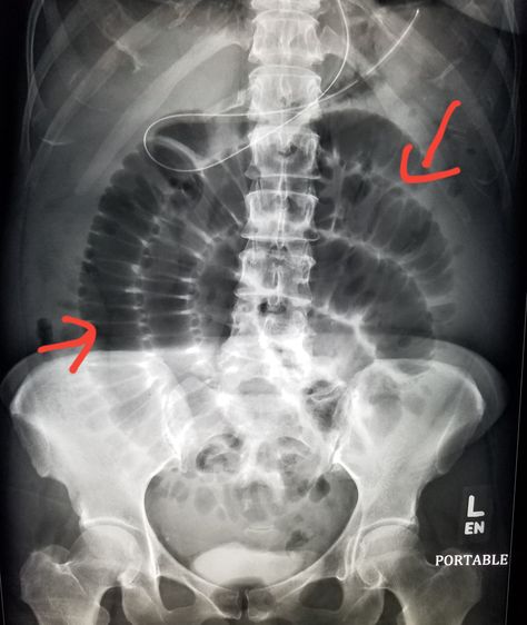 #Abdomen #Xray shows dilated small #bowel from #obstruction (#SBO). #radiology #radiologist #pain Abdomen Xray, Medical Radiography, Abdomen Tattoo, Exercise Abdomen, Large Tattoos, Nursing Education, Radiology, Medical School, Ultrasound