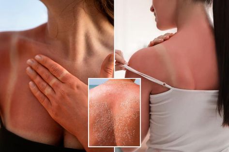 Sunburn or sun poisoning? How to tell if you’ve gotten too much sun Sun Poisoning, Weird But True, Parenting Styles, Men’s Health, Health And Nutrition, Womens Health, Vinegar, Too Much, To Tell