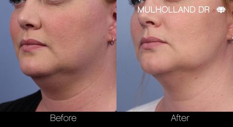 Watch our quick video on our Facebook to see how Dr.M helped get rid of the double trouble double chin! Double Chin, After Photos, Double Trouble, The Double, Instagram