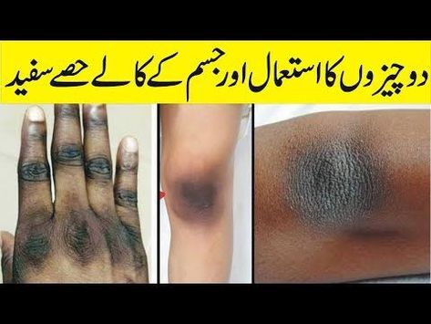 Dark Knees And Elbows, Dark Knees, Dark Elbows, Natural Face Cleanser, Beauty Tips In Urdu, Newborn Feeding, Perfect Skin Care Routine, Health Planner, Cold Remedies