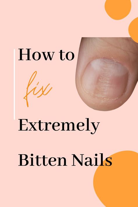 Japanese gel,
Bitten Nails Bitten Nails, Nail Pops, Nail Biting, Japanese Nails, Nail Forms, Always Remember, Nail Tech, Master Class, Fix It