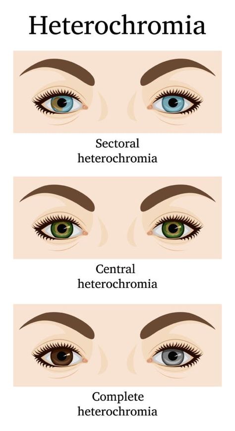 (20) DocXus on X: "What’s this condition called? Cause ? https://t.co/KqIRmT6IlK" / X Sectoral Heterochromia, Heterochromia Iridum, Central Heterochromia, Heterochromia Eyes, Two Different Colored Eyes, Multi Colored Eyes, Rare Eyes, Blue Eye Color, Eye Parts