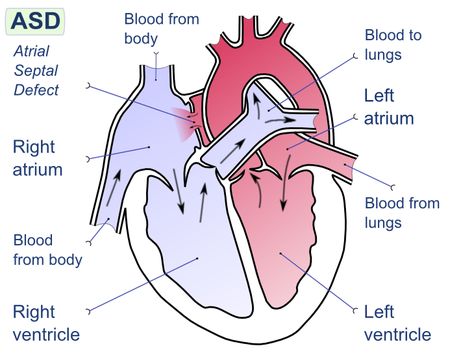 Cardiac Pathology, Right Coronary Artery, Percutaneous Coronary, Cardiac Tamponade, Coronary Angiography Views, Tetralogy Of Fallot Heart, Atrial Septal Defect, Heart Diagram, Penyakit Jantung