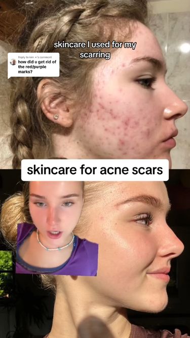 4 Products You need to Heal Acne Scarring Skincare For Acne, Clear Skin Diet, Forehead Acne, Skincare Guide, Skin Diet, Acne Solutions, Facial Skin Care Routine, Boost Your Confidence, Face Skin Care