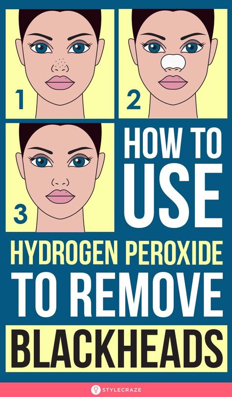 How To Use Hydrogen Peroxide To Remove Blackheads To Remove Blackheads, Blackheads On Nose, Cold Medicine, Home Remedy For Cough, Cold Sores Remedies, Remove Blackheads, Natural Sleep Remedies, Natural Cold Remedies, Get Rid Of Blackheads