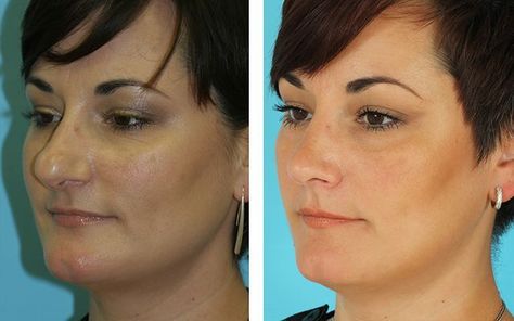 Bulbous Nasal Tip - Before & After - Figure 2 Contour For Round Face, Nose Surgery Rhinoplasty, Bulbous Nose, Plastic Surgery Fail, Nose Jobs, Facial Procedure, Rhinoplasty Nose Jobs, Plastic Surgery Gone Wrong, Rhinoplasty Before And After