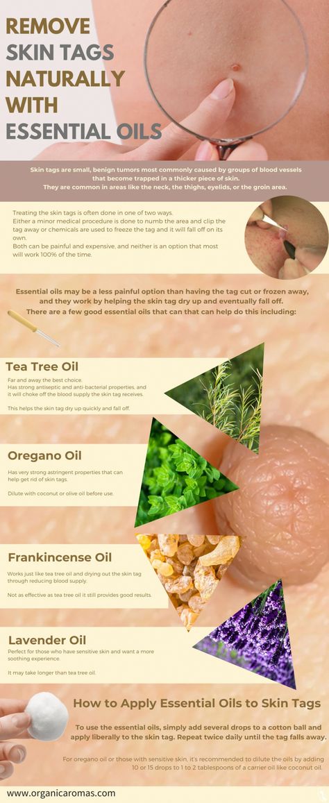 Skin Tags Essential Oils, Remove Skin Tags, Remove Skin Tags Naturally, Home Remedy For Cough, Skin Tags, Cold Sores Remedies, Essential Oils For Skin, Natural Sleep Remedies, Natural Cold Remedies