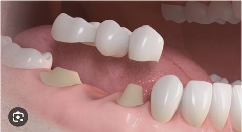 ￼ COTIZACIÓN ROSIRIS SIERRA ⁃ Extraccion dientes (6) $90.000 C/U TOTAL: $540.000 ⁃ Protesis removible inferior flexible (1 opción) $500.000 ￼ ⁃ Implantes mucosoportada para protesis inferior 4 unidades (2 opción) $ 1.800.000 C/U TOTAL: $7.200.000 ⁃ Coronas para implantes inferiores 11 unidades $800.000 C/U TOTAL: $8.800.000 ￼ - Coronas fijas superiores 6 Unidades $500.00 C/U TOTAL: $3.000.000 (1 opción) ￼ ⁃ Prótesis removible superior $ 42 Dental Bridge, 1 800, Garden Design, Design