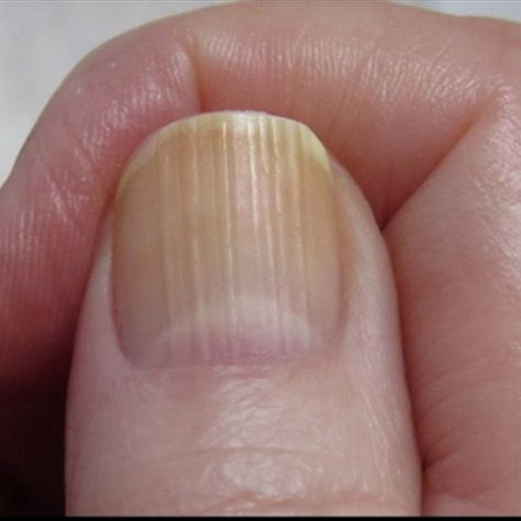 What nails reveal about health | Vertical Ridges Vertical Ridges On Fingernails, Vertical Nail Ridges, Fingernail Ridges, Nail Health Signs, Nail Symptoms, Fingernail Health, Nail Ridges, Nail Conditions, Nail Problems