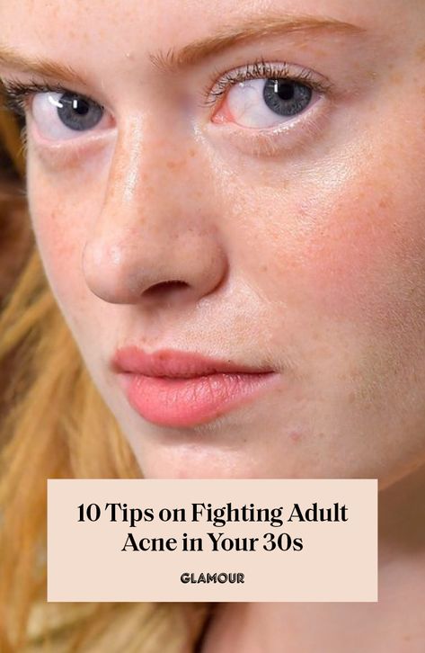 Acne In Your 30s, Forehead Acne, Bad Acne, Skincare Secrets, Natural Acne Remedies, Severe Acne, Types Of Acne, How To Get Rid Of Pimples, Acne Facial