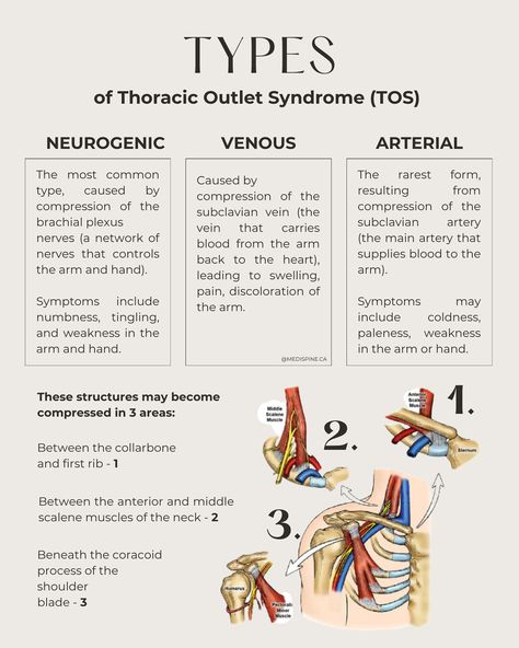 Feeling discomfort in your neck, shoulders, or arms? It could be Thoracic Outlet Syndrome (TOS) 🧨💥 Discover how chiropractic care can help alleviate symptoms and improve your quality of life. From spinal adjustments to postural education, we’ve got you covered 😌🫱🏽‍🫲🏾 SWIPE through to learn more ➡️ ! ____________________________________________ Thoracic Outlet Symptoms, Nbcot Exam, Thoracic Outlet, Physical Therapy School, Manual Therapy, Therapy Exercises, Physiotherapy Clinic, Nursing Student Tips, Medical Student Study