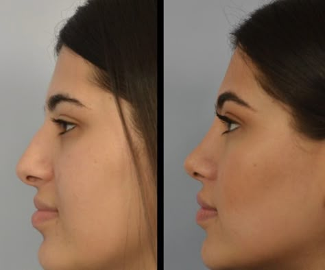 Nose Job Inspiration, Nose Surgery Rhinoplasty, Nose Job Inspo, Ethnic Rhinoplasty, Dream Nose, Bulbous Nose, Rhinoplasty Nose Jobs, Botox Lips, Rhinoplasty Surgery