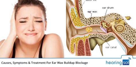 When the earwax becomes so hard to plug that it becomes tough to clean or wash. Best Ear Wax Removal, Ear Wax Candle, Ear Cleaning Wax, Ear Wax Buildup, Dry Skin Routine, Earwax Removal, Dry Skin Remedies, Ear Wax Removal, Women Health Care