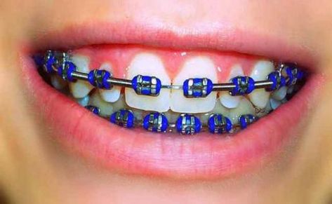 What are some helpful tips to select the ideal color braces? Choose the most popular top braces color wheel - Red, Black Pink, Orange, Yellow, Gold, Green, Blue, Purple, Pink, Black, and White. Dark Blue Braces, Dental Braces Colors, Braces Colors Combinations, Braces Color Wheel, Braces Ideas, Braces Smile, Braces Bands, Ceramic Braces, Cute Braces Colors