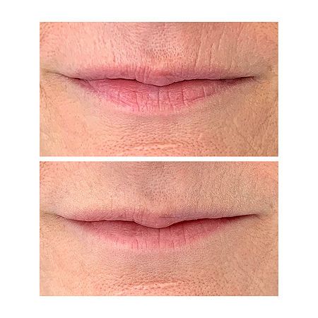 This smooth, waxy-like filler is ideal for instant topical effects and has longer-term benefits. The upper lip area is prone to short, deep, vertical wrinkles that are particularly aging. This take-anywhere magic wand is designed to instantly plump and fill those stubborn lines around the mouth, firm up lip contours and keep your lipstick from feathering. It's also ideal for smoothing out smile lines ( nasal labial folds) and frown lines.Concerns: Loss of Firmness, Fine Lines/Wrinkles, Anti-Agi… Lip Wrinkles How To Get Rid Of, Botox Around Mouth, Lip Line Filler, Upper Lip Wrinkles, Smokers Lines, Anti Aging Skincare Routine, Lip Wrinkles, Lip Contouring, Upper Lip