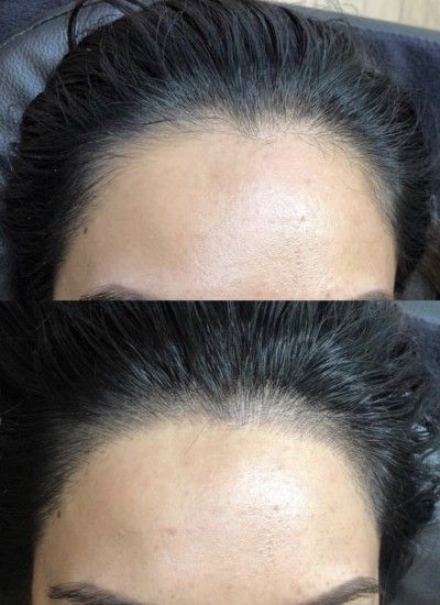 Hairline Microblading. Prolly can't go low enough to deal with my big forehead tho 🤣😂 Hairline Microblading For Women, Microblading Hairline Women, Round Hairline, Hairline Microblading, Hairline Tutorial, Low Hairline, Hair Big Forehead, Long Eyebrows, Facial Aesthetics