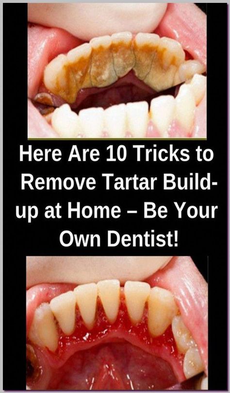 BE YOUR OWN DENTIST! HERE ARE TRICKS TO REMOVE TARTAR BUILDUP AT HOME #WhatIsOralHealthCare Tooth Decay Remedies, Remedies For Tooth Ache, Hygiene Care, Oral Care Routine, Gum Care, Receding Gums, Natural Teeth Whitening, Oral Health Care, Tooth Decay