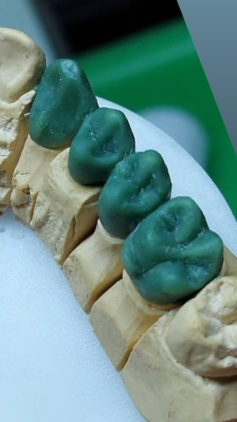 Dentist Ideas, Dental Lab Technician, Dental Ceramics, Esthetic Dentistry, Dental Hygiene Student, Dental Images, Dental Aesthetics, Dental Photography, Dentistry Student