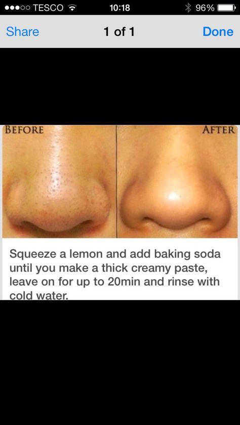 How To Get Rid Of PORES!! Get Rid Of Pores, Obličejové Masky, Skin Moles, Black Heads, Baking Soda Shampoo, Get Rid Of Blackheads, Skin Pores, Clogged Pores, Face Skin Care