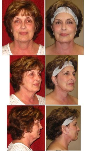 Exercise Methods For The Face And Cheeks - Get Rid Of Loose Facial Tissue And Sagging Jowls Get Rid Of Jowls, Saggy Jowls, Get Rid Of Saggy Skin, Tighten Stomach, Skin Firming Lotion, Sagging Cheeks, Skin Tightening Stomach, Natural Face Lift, Skin Bumps