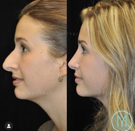 Nose Tip Surgery Before After, Nose Job Before And After Rhinoplasty, Nose Jobs Before And After, Nosejob Rhinoplasty Before After, Plastic Surgery Before And After, Rhinoplasty Before After, Nose Job Before And After, Nose Job Inspo, Before And After Nose Job