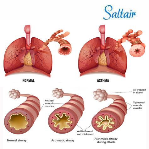 Asthma Pump Aesthetic, Nebulizer Asthma Aesthetic, Clean Lungs, Chest Tightness, What Is Asthma, Emt Study, Work Signs, Home Remedies For Bronchitis, Human Physiology