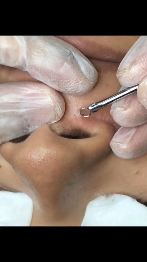 #blackhead #whitehead #blackheadremoval #blackheads #jerawat #acne #pimple #whiteheads #pimples #skincare #blackheadremover #blackheadextraction #pimplepopping #pimplepoppers #drpimplepopper #jeragat #pimplepopper #cyst #pores #whiteheadremoval #pimplepop #drsandralee #pimplesremover #whiteheadextraction #zit #beauty #acnetreatment #cystremoval #skin #zits Bleach Hair Dye, Vitamin C Face Mask, Tea Tree Face Wash, How To Remove Blackheads, Lemon Mask, Blackhead Extraction, Blackhead Remedies, Zit Popping Videos, To Remove Blackheads