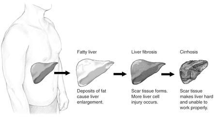 Non Alcoholic Fatty Liver Disease (NAFLD) and Non Alcoholic Steatohepatitis (NASH) Healthy Detox Cleanse, Detox Your Liver, Liver Diet, Liver Failure, Liver Detox, Healthy Liver, Thyroid Hormone, Liver Health, Wall E